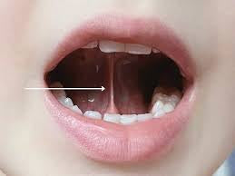 Zungenband, orale Restriktionen & Asymmetrien verstehen, erkennen, begleiten.